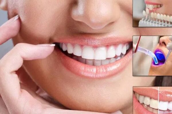 Dental Makeover